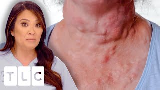 Dr. Lee Removes At Least 20 Cysts From Patient’s Neck! I Dr. Pimple Popper: This Is Zit