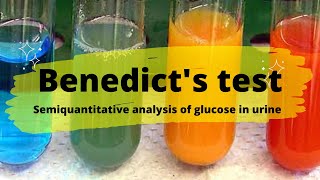 Urine Benedict's Test Procedure | Semiquantitative analysis of Glucose in urine