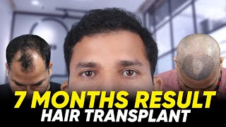 Hair Transplant in Hubli | Best Results \u0026 Cost of Hair Transplant in Hubli