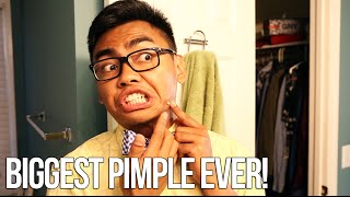 THE BIGGEST PIMPLE EVER - #UpYourGame