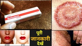 Quadriderm rf use side effects hindi|| Quitoderm cream uses in hindi