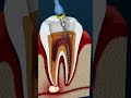 What is a Root Canal? Do I need a Root Canal? #rct #dentist #dentalcrowns #teeth