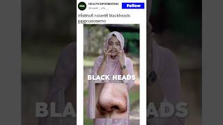 നിങ്ങൾ NOSEൽ BLACK HEADS ഉള്ളവരാണോ