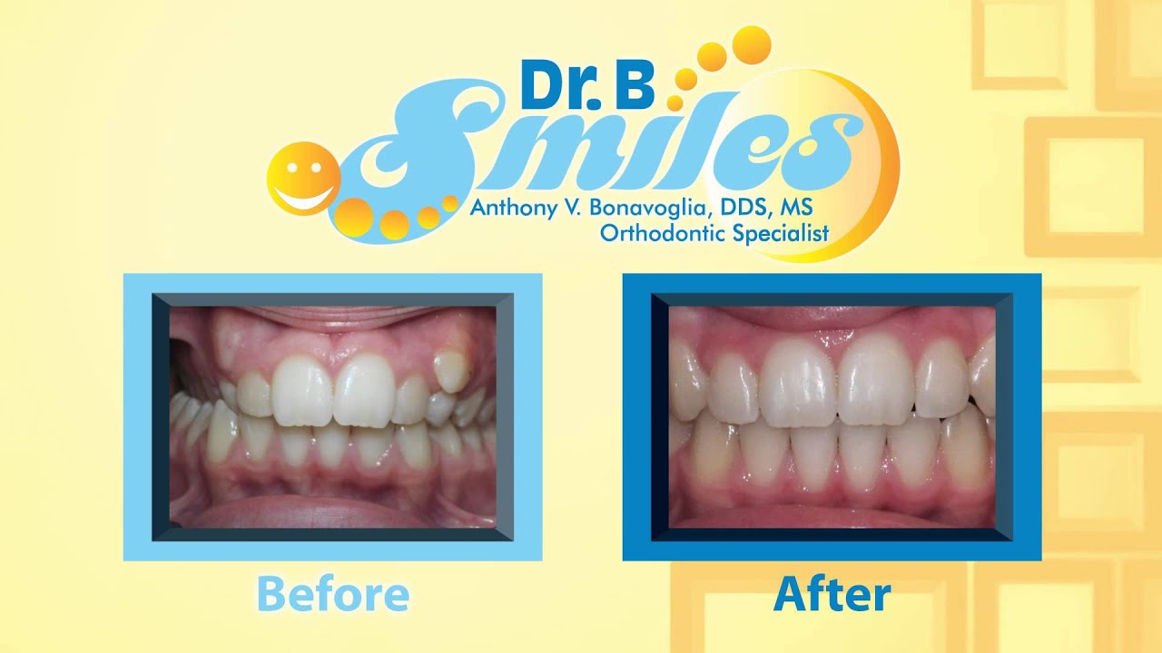 Before And After 2-- Dr. B Smiles - YouTube