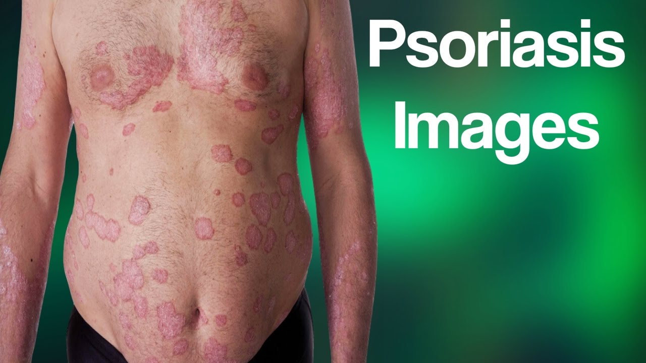 Psoriasis Images, Plaque Psoriasis, Psoriasis Of The Scalp, Best Cream ...