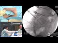 live demo percutaneous long segment fixation jeffrey s. roh md mba