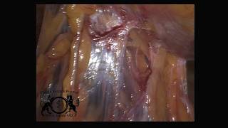 Laparoscopic lysis of adhesions for abdominal pain