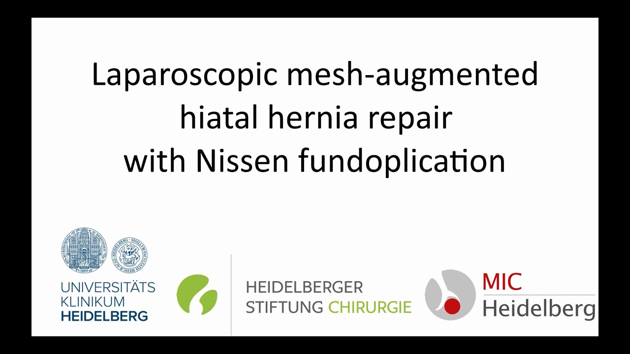 Laparoscopic Mesh-augmented Hiatal Hernia Repair With Nissen ...