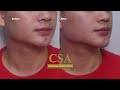 Getting rid of double chin without surgery via jawline and chin filler