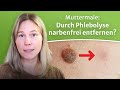 Muttermale und Leberflecke ohne Narbe und schonend entfernt durch Phlebolyse - ein Patientenfall!