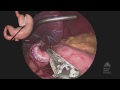 the mount sinai surgical film atlas laparoscopic roux en y gastric bypass