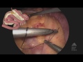 the mount sinai surgical film atlas laparoscopic roux en y gastric bypass