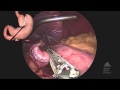 THE MOUNT SINAI SURGICAL FILM ATLAS Laparoscopic Roux en Y Gastric Bypass