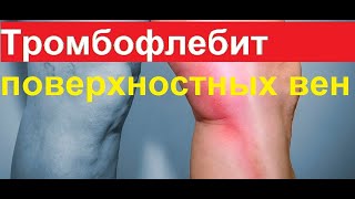 Тромбофлебит поверхностных вен