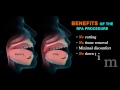 treating sleep apnea with the rfa procedure