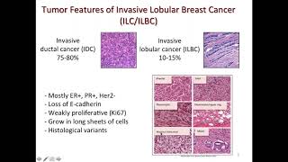 Invasive Lobular Carcinoma: Highlights from the First Ever ILC Symposium