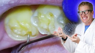 Dentist Treats Tooth Erosion With A Filling for Worn Down Enamel!