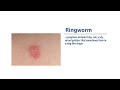 skin infections ringworm