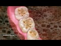 Dental Erosion