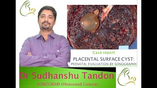 Placental Surface Cyst I Dr Sudhanshu Tandon I Sonogram l Pregnancy Ultrasound