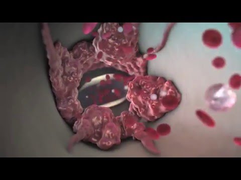 What Are the Symptoms of a Blood Clot in Your Lung? What Are the Symptoms of a Blood Clot in Your Lung?