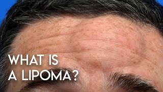 What is a Lipoma?