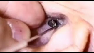 MASSIVE EARWAX REMOVAL