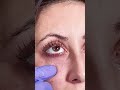 Fixing Hollow Eyes with Under Eye Filler