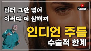 인디언 주름, 무조건 필러 많이 넣어주면 좋아질까?