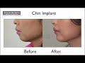 chin implant animation video how is a chin implant inserted