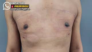 বড় স্তন অপারেশন না করলে কি হয়? Gynecomastia surgery করা কেন জরুরি