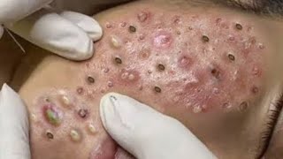 Just the Pops| @harispaoffice5852 Blackhead Pops.