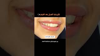 روعة تقويم الأسنان orthodontics #dr_teeth_dento #الشعب_الصيني_ماله_حل #dentist #اكسبلور #satisfying