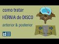 Como tratar hérnia de disco anterior e posterior