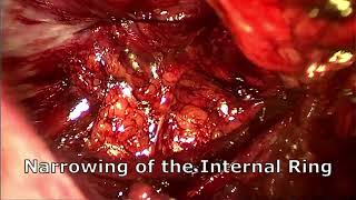 Laparoscopic Inguinal Hernia Repair (TEP 15, TEP Plus PIRS)