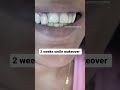 smile makeover in 2 weeks by Dr Trivikram with porcelain veneers