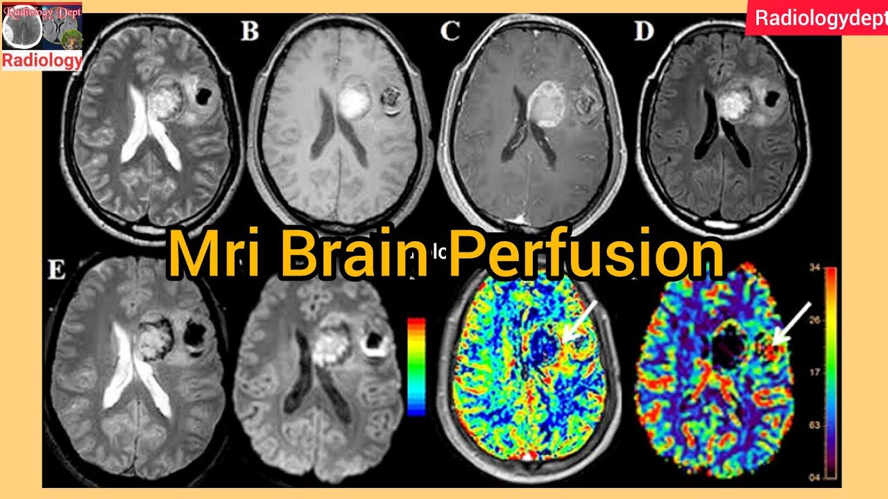 Mri Brain Perfusion Study || #perfusion @Radiologydept - YouTube