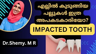 Impacted tooth|| എല്ലിൽ കുടുങ്ങിയ പല്ല് പ്രശ്നങ്ങൾ എന്തെല്ലാം|| Dr Shemy