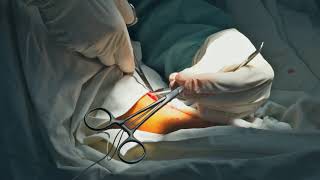 Varicose Vein Surgery: Vein Stripping