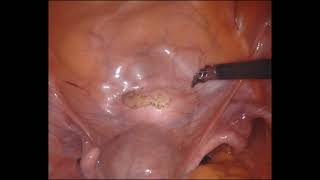 Easy Excision of Early bladder endometriosis , LUNA , Uterine suspension