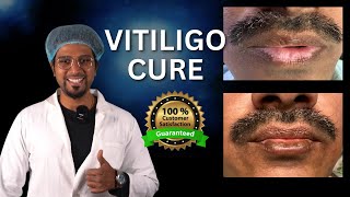 Vitiligo Treatment On Lips | No surgery, No tablets | Machu Tattoos | Marathahalli Bangalore