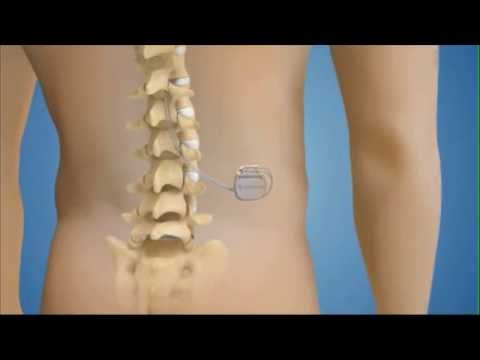 Spinal Cord Stimulation System For Chronic Pain - YouTube