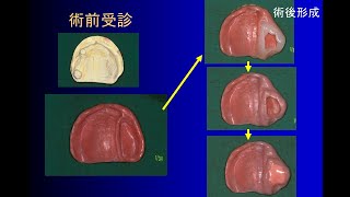 部分床義歯7回目_講義動画_各種補綴装置