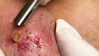 Cystic Acne Blackhead and Whitehead Removal This Week 𝟐𝟎𝟐𝟑 (p2)