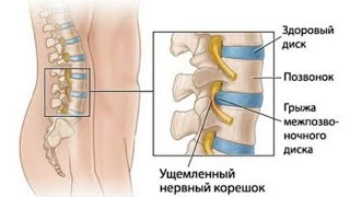 ДИСК ГРЫЖАСИ БУЙИЧА ДАВОЛАШ УСУЛЛАРИ