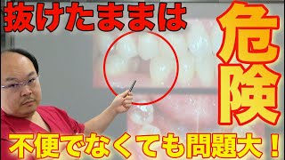 【和歌山 歯科】歯が抜けたままは危険ということをご存知ですか？不便でなくても問題大ですよ。