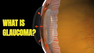 Glaucoma: Signs and Treatment (3D Animation)