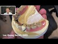 Partial Denture, Denture, Implants Overdenture.