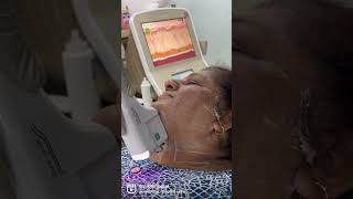 Skin tightening HIFU face treatment | No surgery face lift| Best skin clinic Thane #antiageing