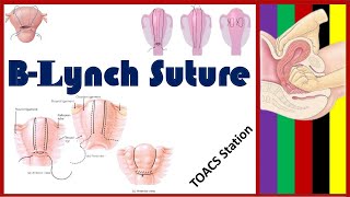 B Lynch Suture | B Lynch Brace Suture | Uterine Compression Suture | Stepwise Devascularization